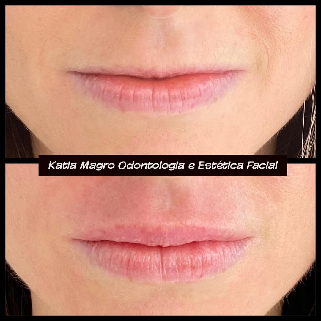 Harmonização Labial (antes e depois)